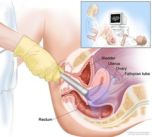 xét nghiệm ung thư cổ tử cung