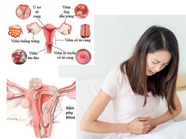 điều trị viêm âm đạo