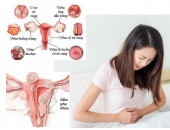 Điều Trị Viêm Âm Đạo Dứt Điểm | An Toàn Hiệu Quả Không Biến Chứng